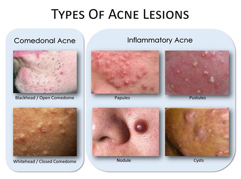 Acne Whats The Deal
