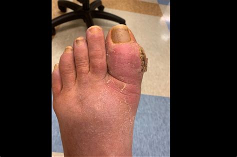 Ortho Dx Erythema Swelling And Pain Of The First Toe Clinical Advisor