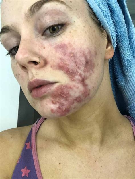 Woman With Acne Devastated As Trolls Steal Pictures To Give Her A Makeover Metro News