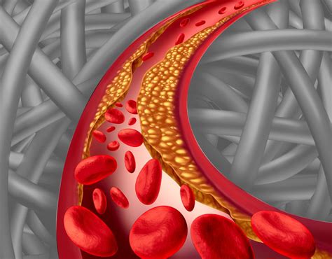 Peripheral Artery Disease Cardio Flow