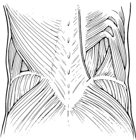 Figure 1 From Primary And Unusual Abdominal Wall Hernias Semantic