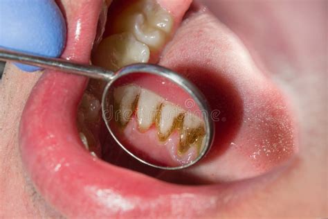 Tartar Close Up On The Lower Anterior Incisors Dental Hygiene Of Teeth