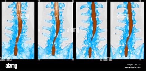 Will A Ct Scan Show Spinal Stenosis Ct Scan Machine Images And Photos