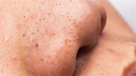 Acne Pop Up Comedones Zel Skin And Laser Specialists
