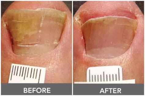 Download in under 30 seconds. Toenail Fungus, Pictures, Causes, Symptoms, Get Rid, Cure ...