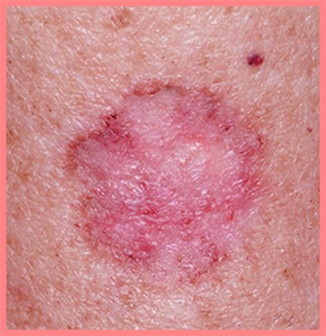 Skin Diseases Bing Images