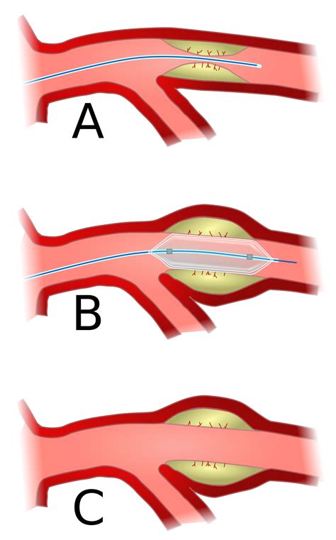 Angioplasty Wikipedia