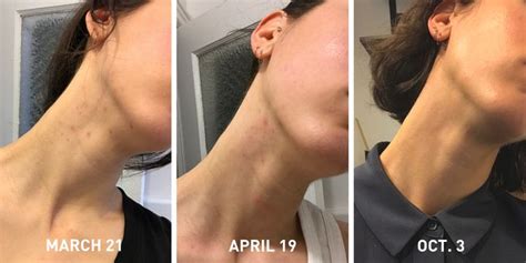 How I Treated The Hormonal Acne I Got From Birth Control Huffpost Life