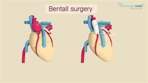 Bentall Surgery Cost In India Types And Procedure Medsurge India