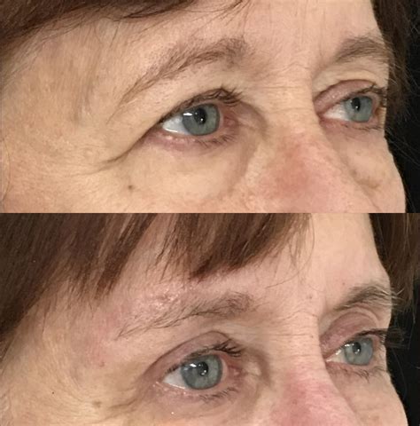 Brow Lift Before And After Photos Flora Levin Md