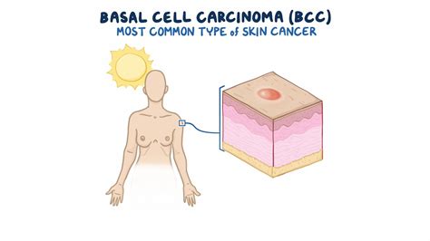 Basal Cell Carcinoma Clinical Sciences Osmosis Video Library