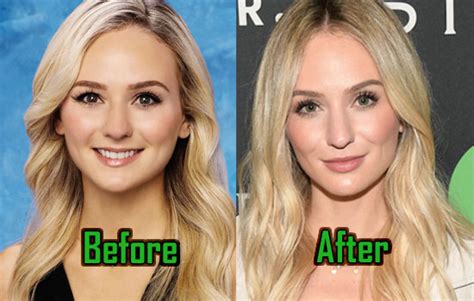 Lauren Bushnell Plastic Surgery Nose Job Lips Injection Before After