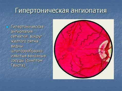 Гипертоническое заболевание диета Ангиопатия сетчатки глаз: причины и симптомы заболевания Ангиопатия сетчатки глаз: причины и симптомы заболевания Гипертоническое заболевание диета