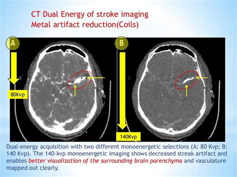 Ct Scan Of The Brain In Stroke Patients