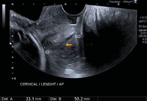 ultrasound scan showing the measurement procedure for the uterine download scientific diagram