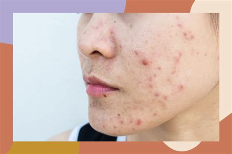 How To Treat Cystic Acne According To Dermatologists Hellogiggles