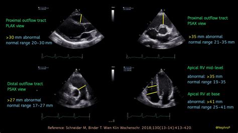 Right Ventricular Size And Measurements On Pocus Echocardiogram