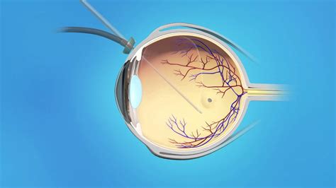 Welcome to wagner macula & retina center, specializing in diabetic retinopathy, macular degeneration, eye tumors, and the diagnosis and management of complex medical and surgical eye disease. Retina Macular Hole Surgery - YouTube