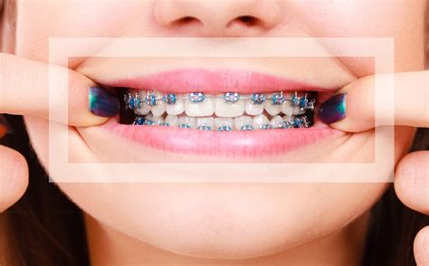 Blue Braces How Do You Pick The Right Color