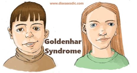 Goldenhar Syndrome Types Complications And Symptoms