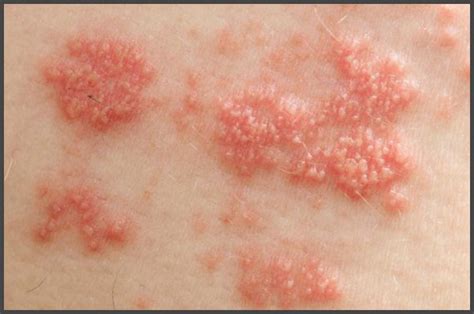 Shingles in groin area pictures | Shingles Expert