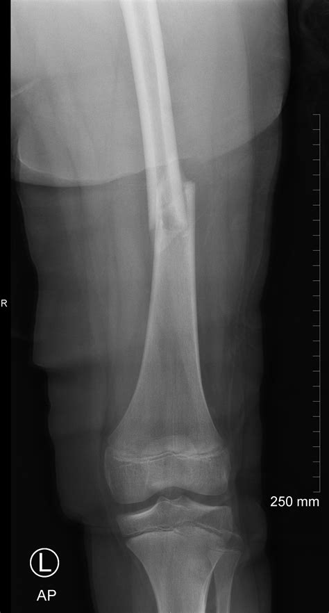Unicameral Bone Cyst With Fracture Femur Image