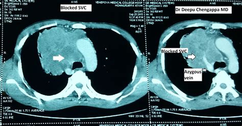 Chest Medicine Made Easy Dr Deepu Image Archives Svc Obstruction Ct