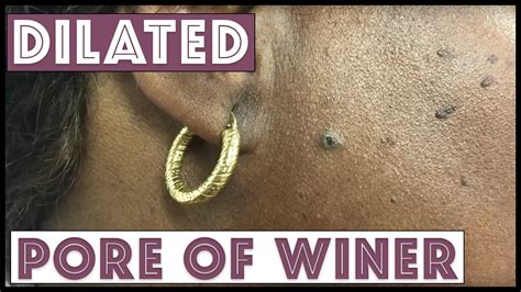 Two Small Dilated Pore Of Winers On The Face Youtube