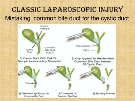 Bile Duct Injuries Following Laparoscopic Cholecystectomy World