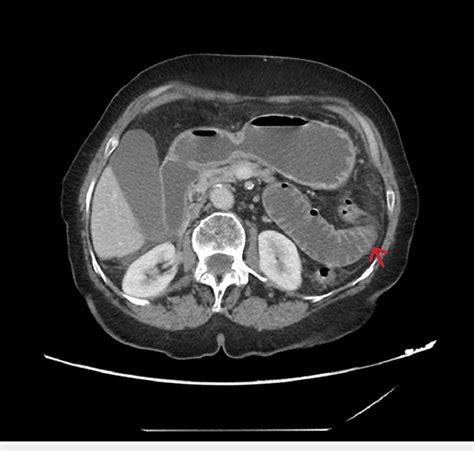 Abdominal Ct In Axial View Showing Focal Obstruction With The