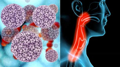 Luckily, these noticeable changes often lead to an earlier diagnosis and are one of the early throat cancer symptoms, according to the american cancer society. 5 Things to Know About HPV-Related Throat Cancer