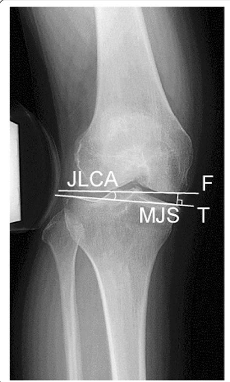 Measurement Of The Medial Joint Space Mjs And Joint Line Convergence