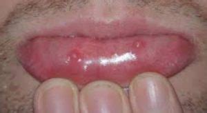 They can be quite distressing, painful and make the act of swallowing a bit cumbersome. How to Get Rid Of Mucous Cyst on Lip, Roof of Mouth ...