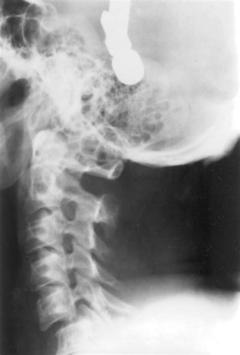 Figure 2 From Irreducible Dislocations Of The Cervical Spine With A