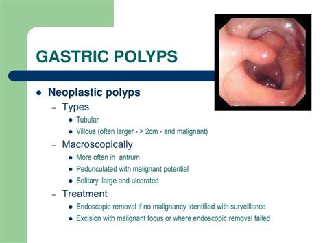 Types Of Gastric Polyps