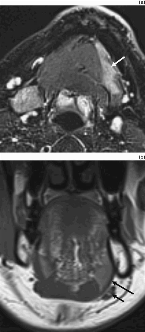 Submandibular Gland Ectopia Associated With Atrophy Of Floor Of Mouth