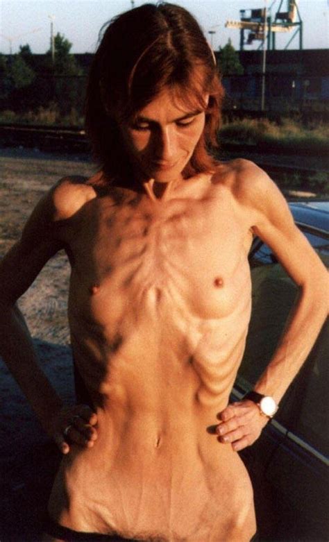 Free Extreme Anorexic Nude Qpornx Hot Sex Picture