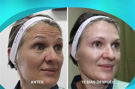 Botox En La Cara Antes Y Después Simplemente No Deben Tomarse Aspirinas Ni Otras Medicaciones