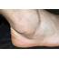 Swollen Ankle  Stock Image M330/1597 Science Photo Library