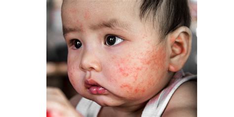 Untuk memastikan demam atau tidak. Ruam Merah Pada Bayi Setelah Demam - Informasi Kesehatan 2020
