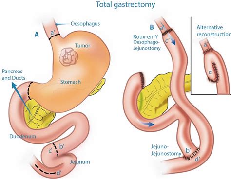 Gastrectomy Types Post Gastrectomy Diet And Life After Total Gastrectomy