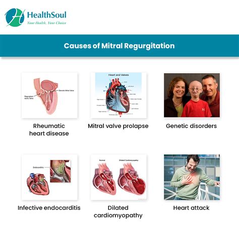 Mitral Regurgitation Symptoms And Treatment Cardiology