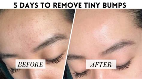 5 Days To Remove Tiny Bumps On Your Face Glowpink