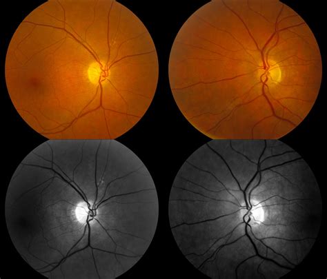 Whitman Images Rpe Window Defect In The Right Eye