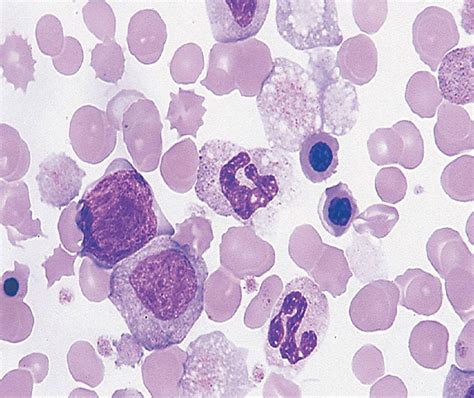 Myeloproliferative Neoplasms Rodaks Hematology Clinical Principles