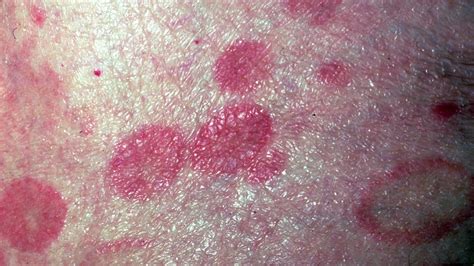 T Cell Lymphoma Skin Rash Cutaneous T Cell Lymphoma The Rashes Are