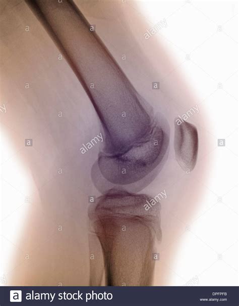Normal Knee X Ray Stock Photo Alamy