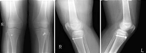 Figure From Operative Treatment Of Bilateral Tibial Tuberosity