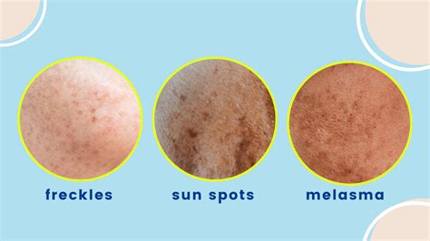 Ultimate Guide To Hyperpigmentation Types Causes And What To Do