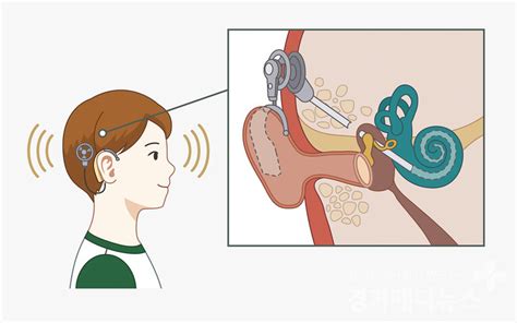 서울아산병원 인공와우이식수술 환자 청각 재활 돕는 앱 개발 경기메디뉴스